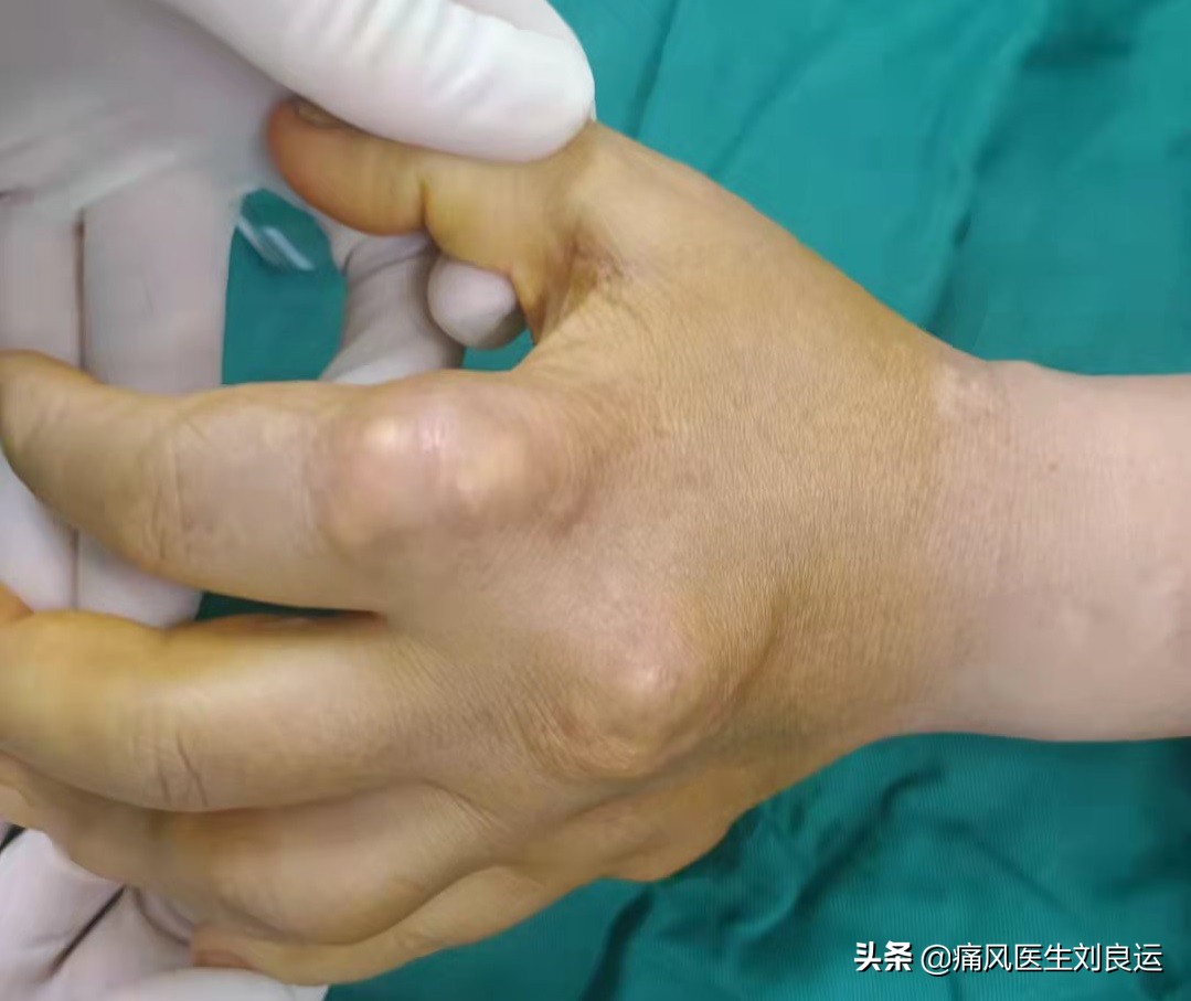 痛风富贵病,饮食很清淡但犯痛风了