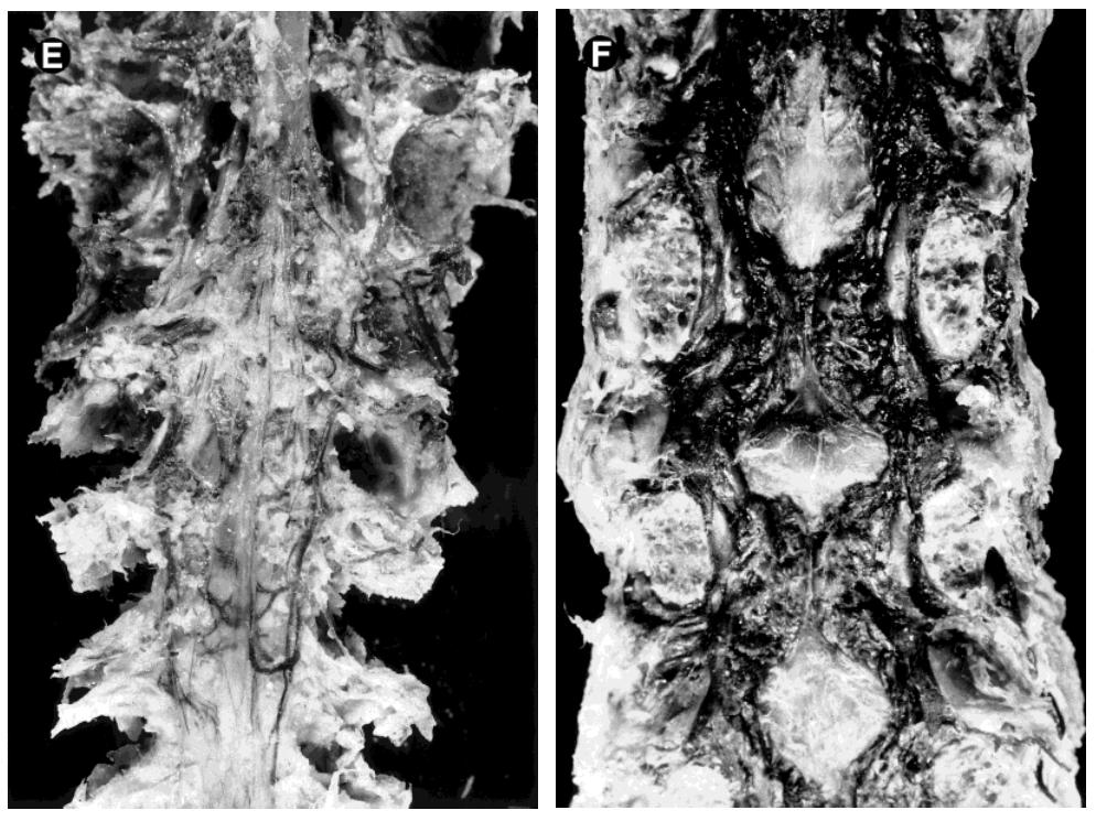 文献查阅|文献综述——椎静脉丛