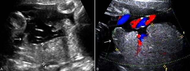 前置胎盘的超声表现及鉴别诊断,胎盘超声显像检查