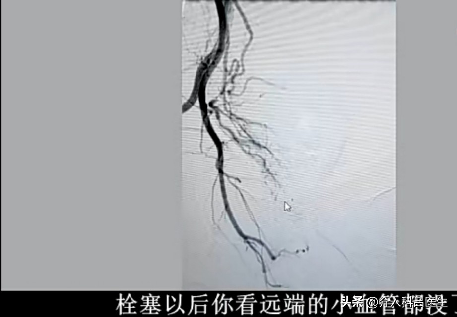 不死的癌症肠易激综合征,不死的癌症中医治疗