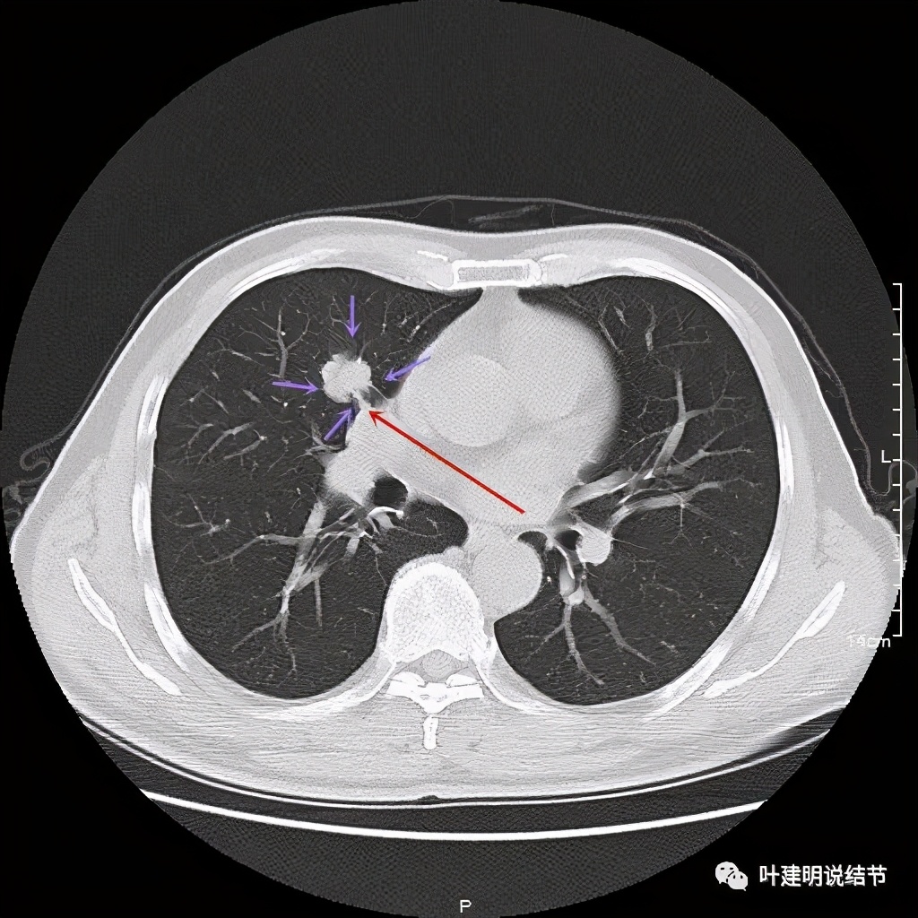 实性结节影要不要紧,实性结节穿刺活检为良性