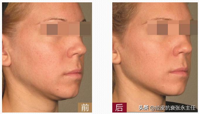 做筋膜拉皮手术效果维持多久,额头拉皮手术能维持几年