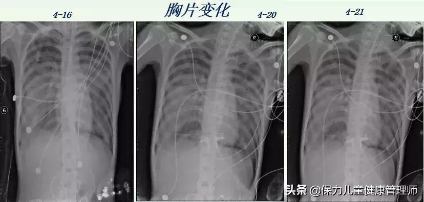 死亡率高达50%,死亡率高达50%到80%
