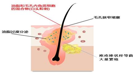 长痘为什么要给皮肤消炎,正确战痘第一步认清痘痘真面目