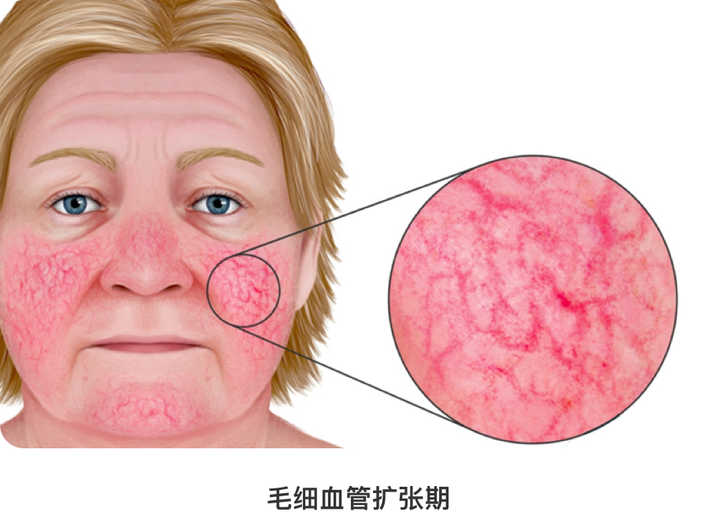 玫瑰痤疮反复发作怎么治疗,痤疮常见皮损不包括