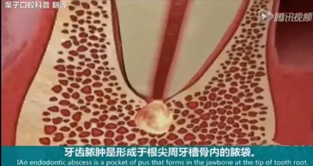 牙龈反复鼓包流脓是牙齿坏了吗,一上火牙龈就鼓包