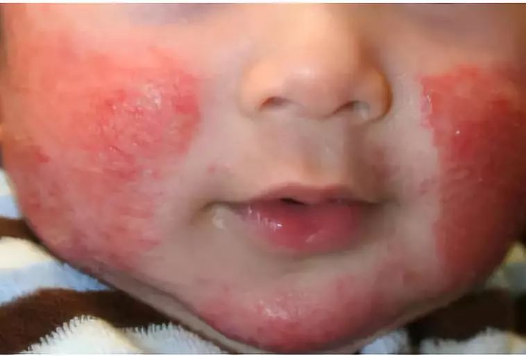 婴儿干性湿疹抹护肤品没有激素,宝宝湿疹要选抗过敏保湿护肤品