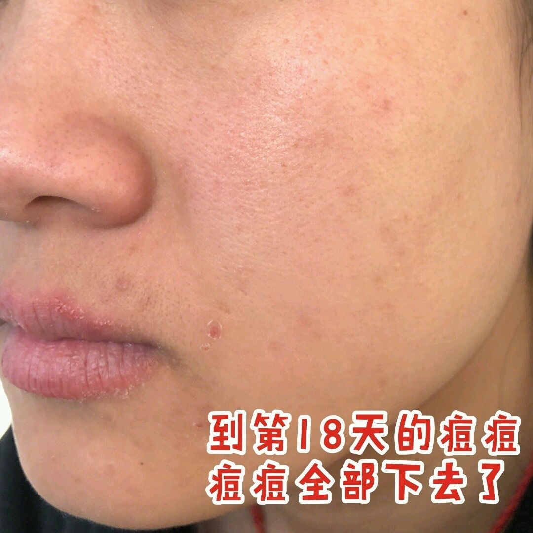 祛痘印最好的6个方法,祛痘印得最快的药膏