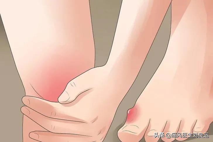 痛风和高血糖,痛风跟血糖高适合吃什么