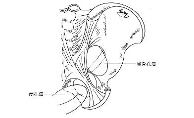 腹股沟疝有几种类型如何鉴别,腹股沟疝有哪些特点