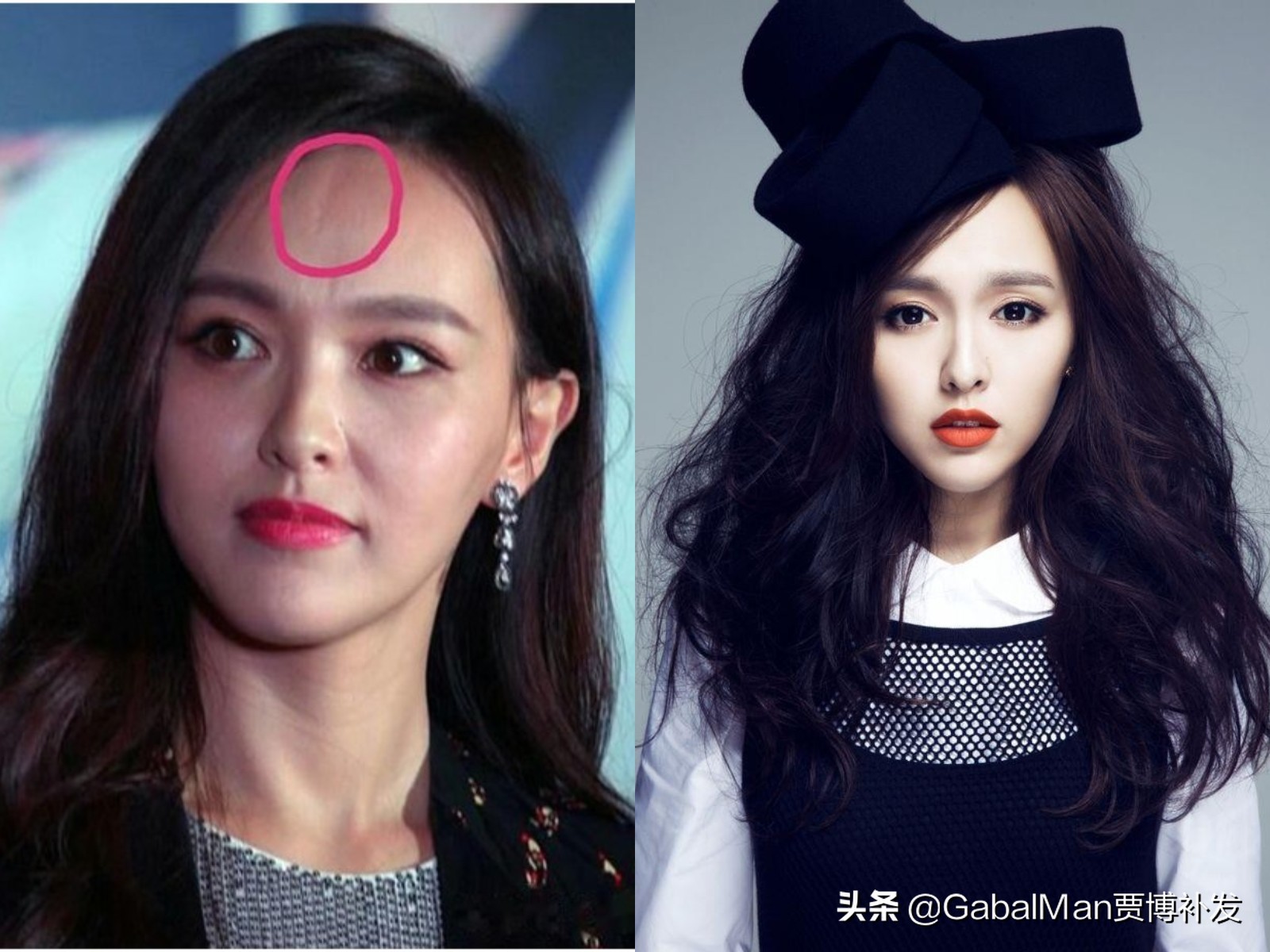 拯救发际线的最佳方法,如何拯救发际线过高