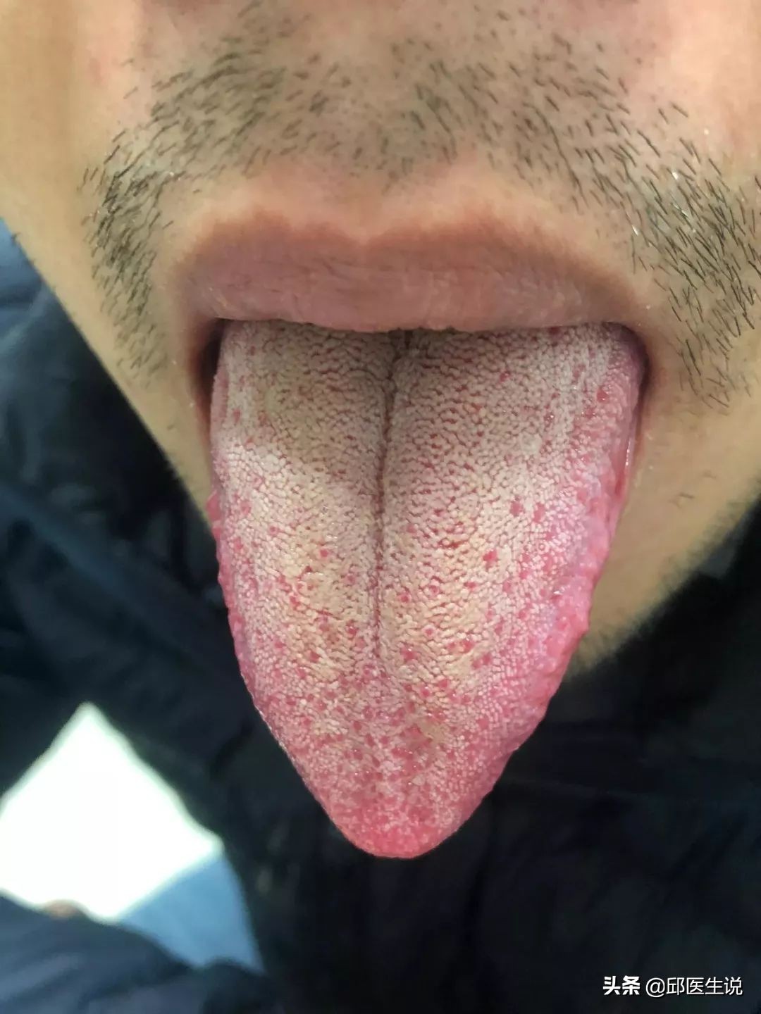 解决身体的湿气的偏方,身体湿气太重自己在家怎样除掉