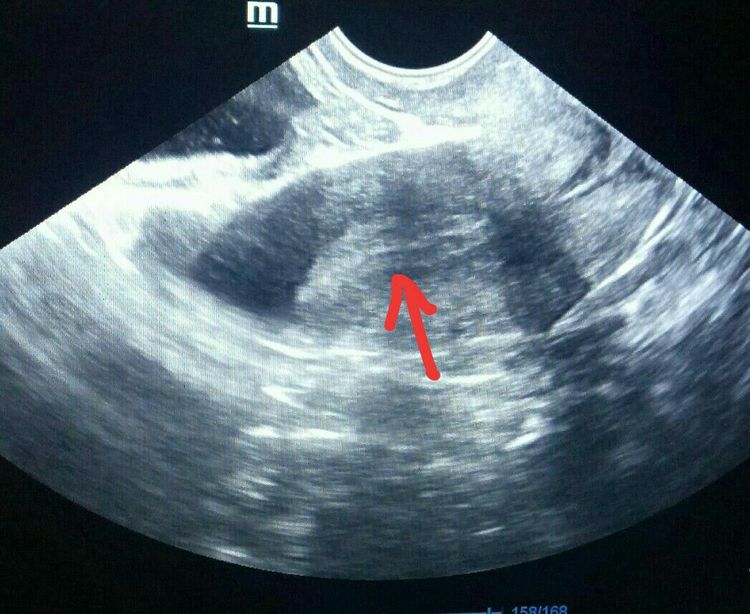 胚胎移植前需要如何调理内膜,胚胎移植前怎么调理内膜