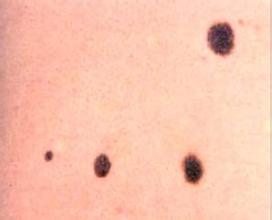 先天性色素痣多大治疗比较好,色素痣的治疗方法都有哪些呢