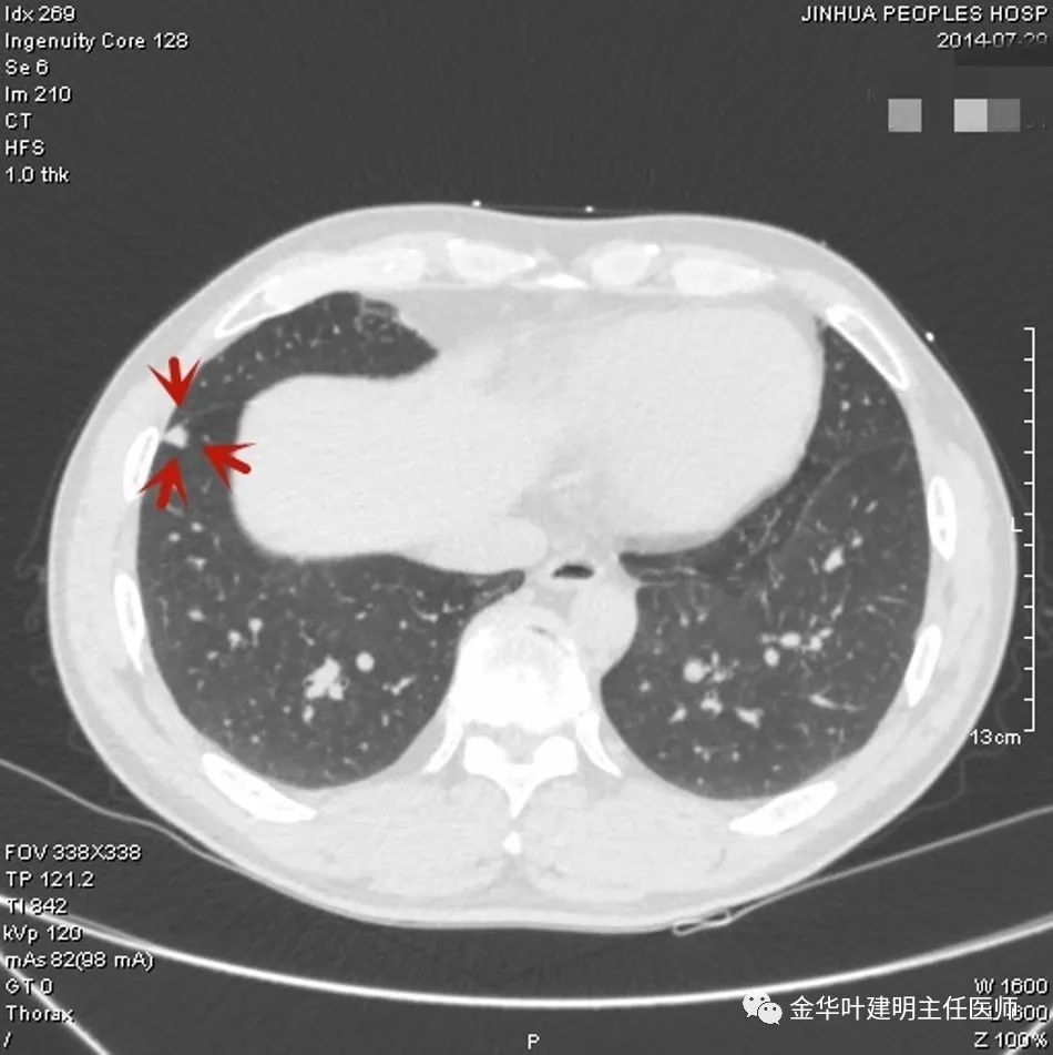 叶建明谈胸膜下的实性结节,叶建明肺实性良性结节会变癌症吗