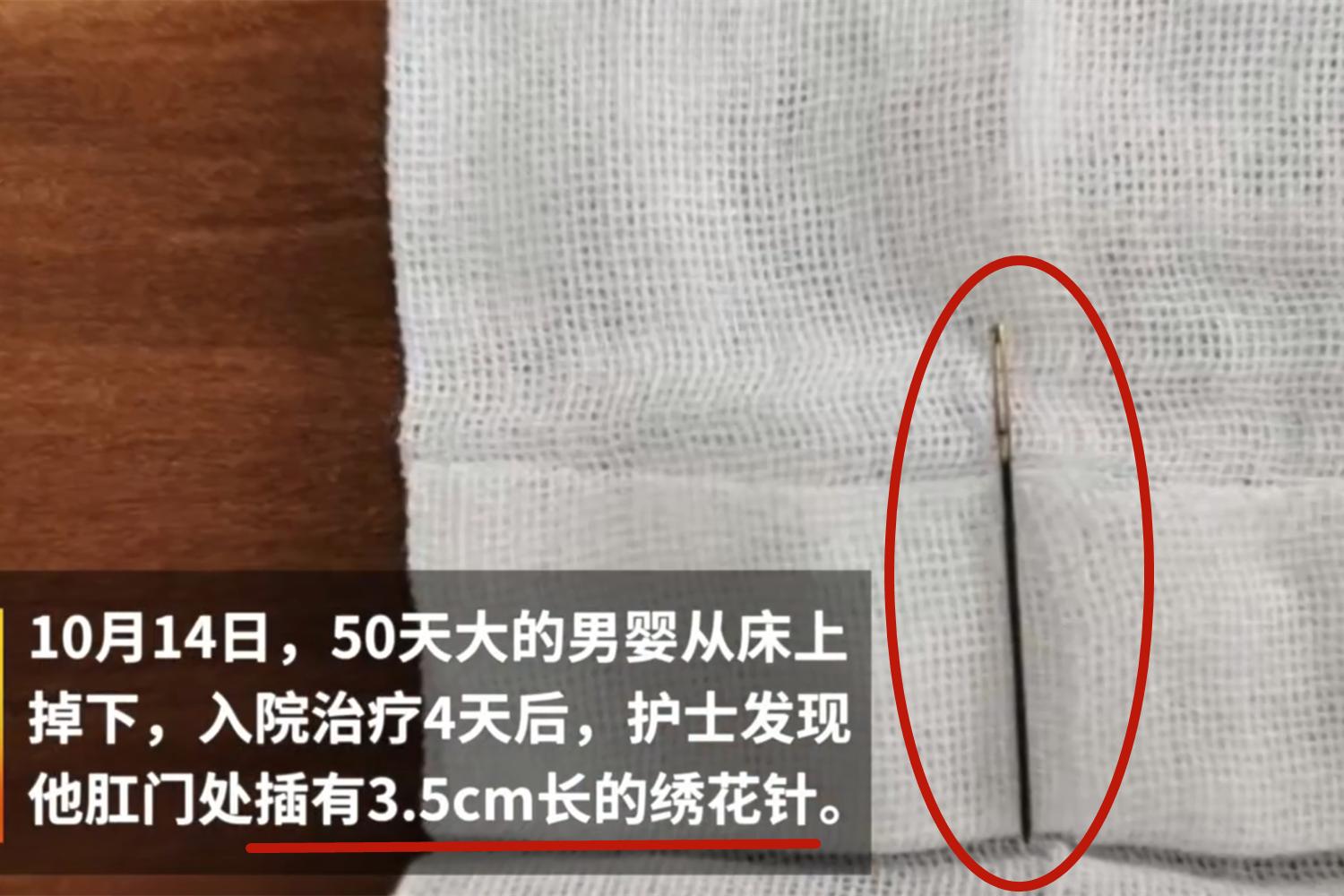 江西2男童体内插绣花针险些丧命,男童体内被插绣花针险些丧命