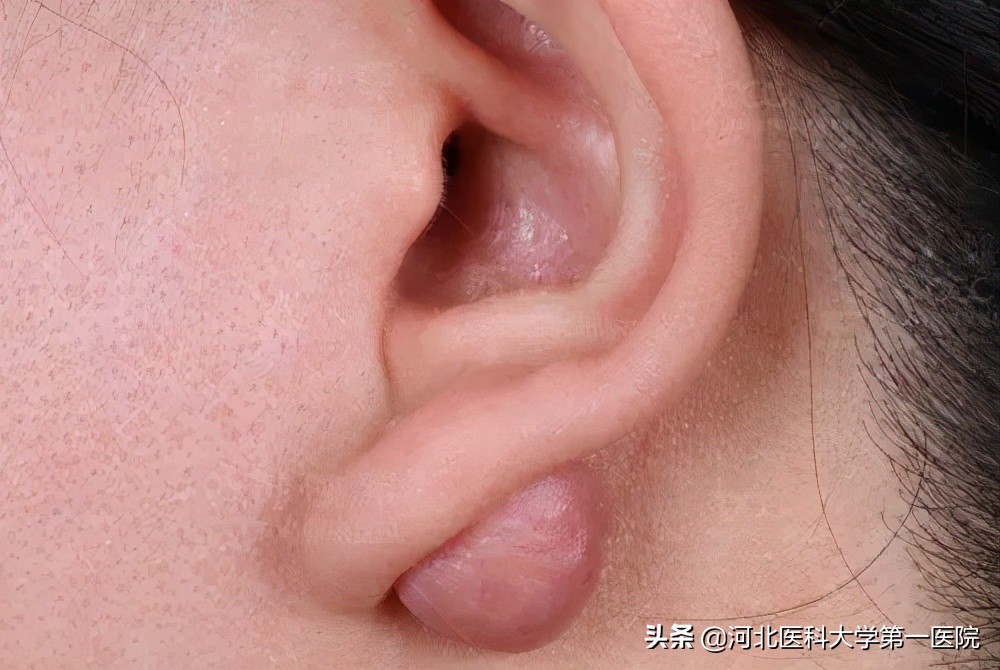 打耳洞为什么会长瘢痕疙瘩,打耳洞导致长了小肉球