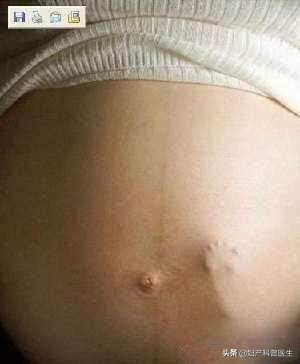 妈妈看场电影，胎儿竟然在宫内拳打脚踢，一检查发现脐带绕颈两周