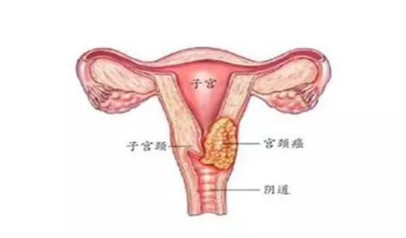 hpv阳性确定是癌症吗,hpv感染到宫颈癌需要漫长时间