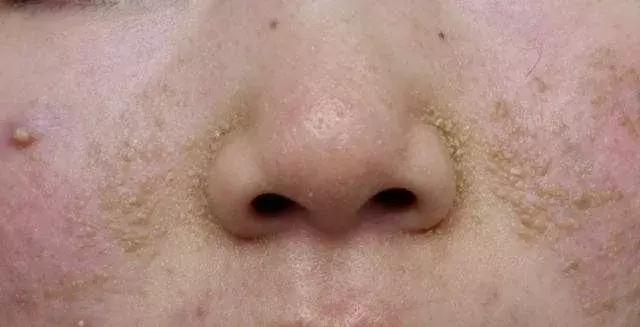 头皮油头皮痒头皮屑多,头皮油头皮屑多头发干枯