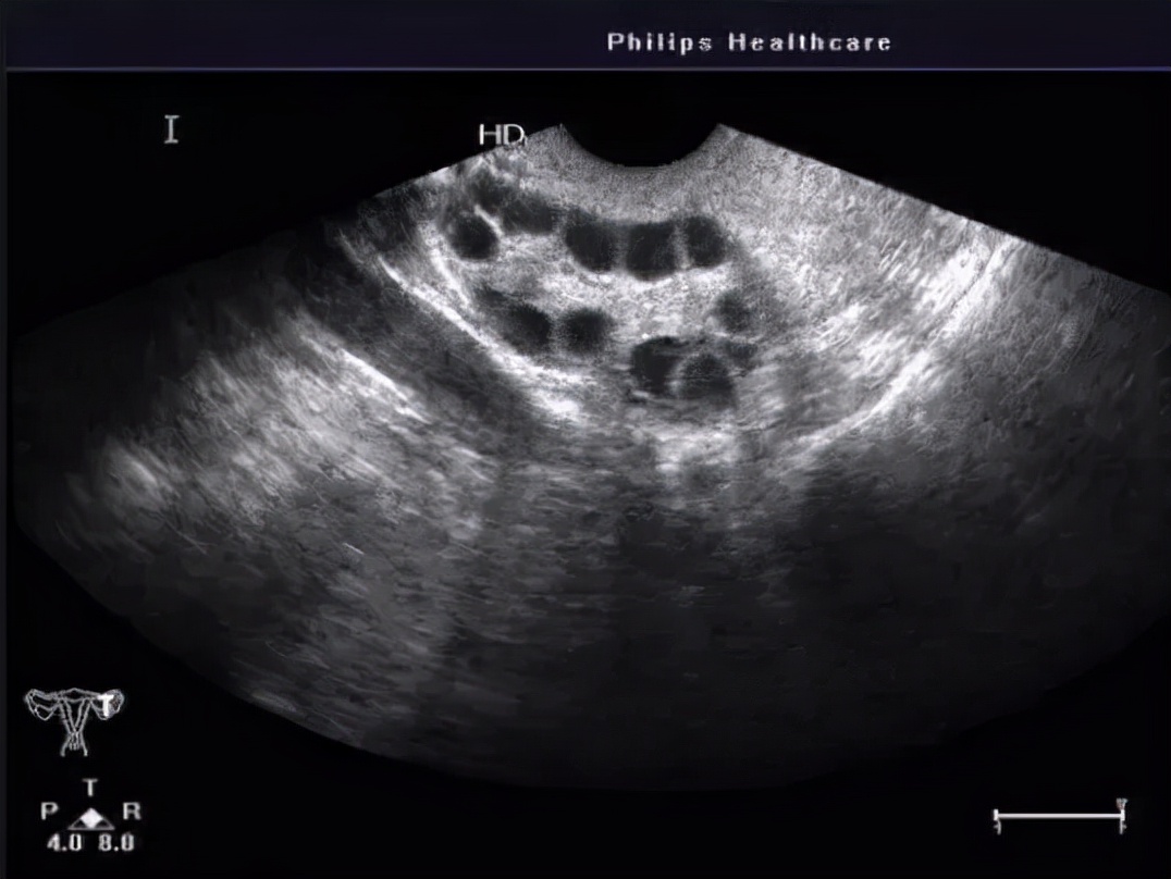 体检发现卵巢囊肿后面复查没有了,月经前体检卵巢囊肿