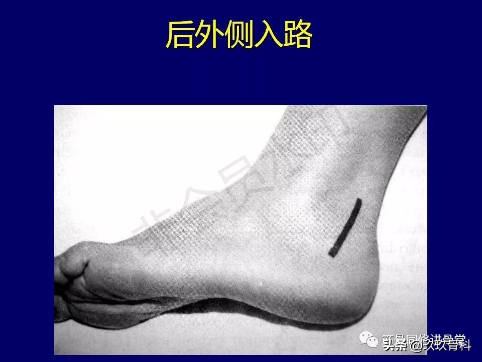 距骨骨折的治疗原则,距骨骨折如何调理