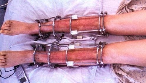 做断骨增高手术会残疾吗,断骨增高术一般可以增高几厘米