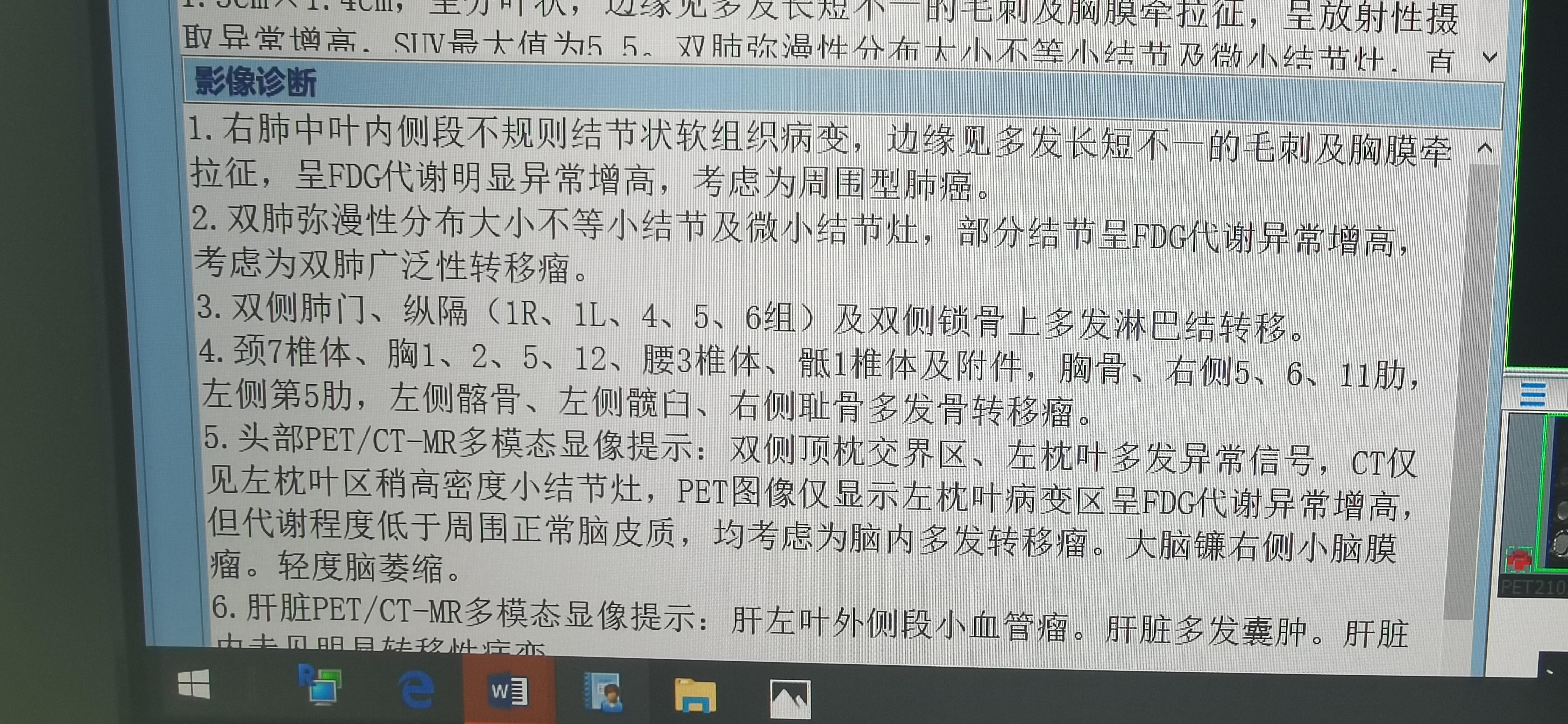 肺癌双肺弥漫转移生存期,肺结节小但是骨转移