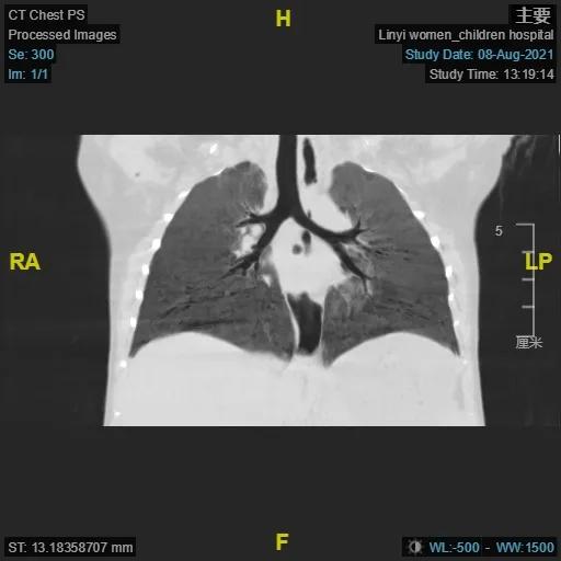肺炎支气管镜一般费用多少,肺炎不好反复发烧