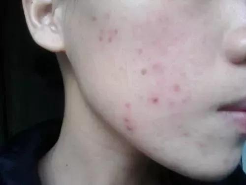 祛痘和祛痘印的方法一样吗,祛痘和祛痘印最好的方法是什么