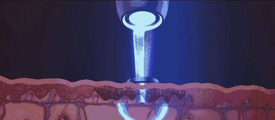 贝克氏母斑是皮秒好还是超皮秒好,皮秒跟超皮秒蜂巢皮秒有什么区别