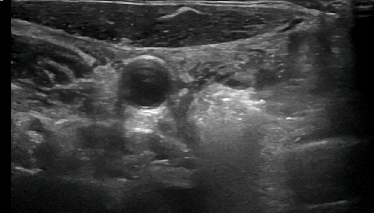 甲状腺结节微波消融术,厦门有微波消融术治疗甲状腺结节