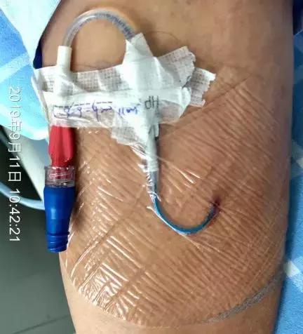 护士picc导管维护,护士picc相关知识薄弱