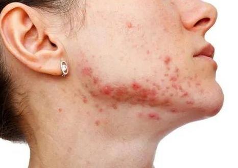 脸上长痘是身体原因还是皮肤原因,脸上长痘可能是什么病引起的