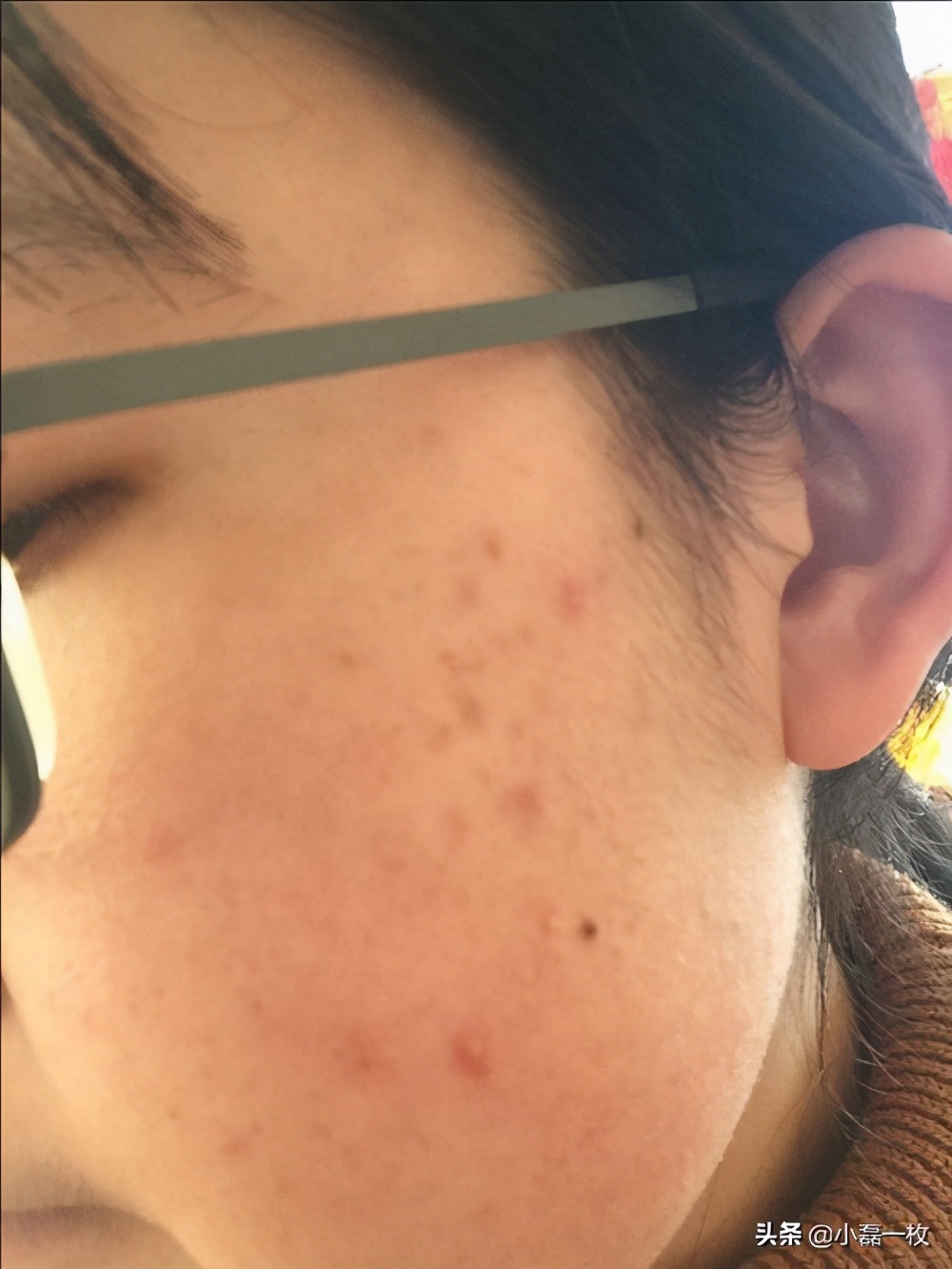 真正有效的祛痘印产品推荐,有什么很好的祛痘印产品