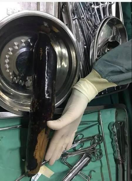 医生辟谣手术,医生辟谣剖腹产出院