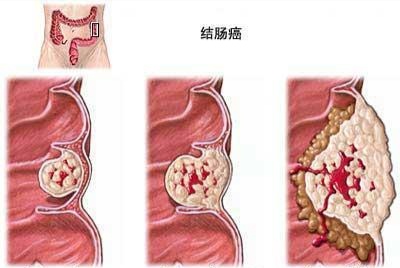 看似和癌症不相关的一些“小症状”,你注意过吗?