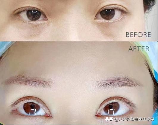 平行式双眼皮变成普通窄双眼皮了,悲伤蛙双眼皮图片