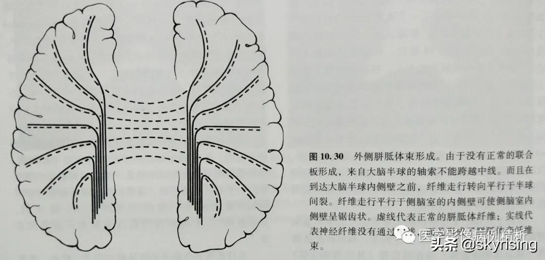半叶全前脑畸形,无叶型前脑无裂畸形超声表现
