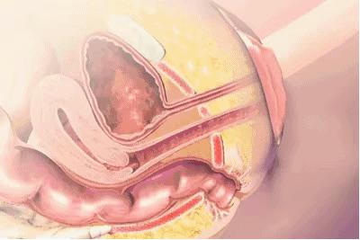 产后下垂要做盆底肌修复吗,产后真的要做盆底肌修复吗