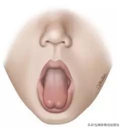 哺乳疼痛、乳头皲裂、乳腺炎这些哺乳难题，可能是舌系带短导致