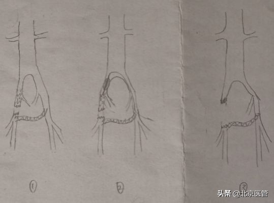 肾移植复发最新治疗,肾移植术后出现急性排斥能治愈吗