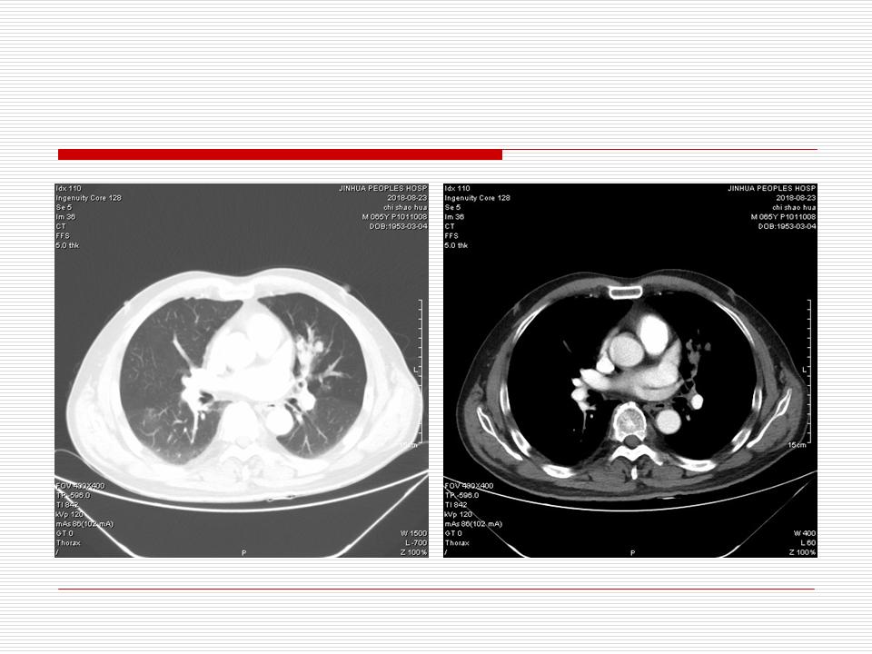 像炎症的肺癌能治好吗,医生说可能是肺癌也可能是炎症