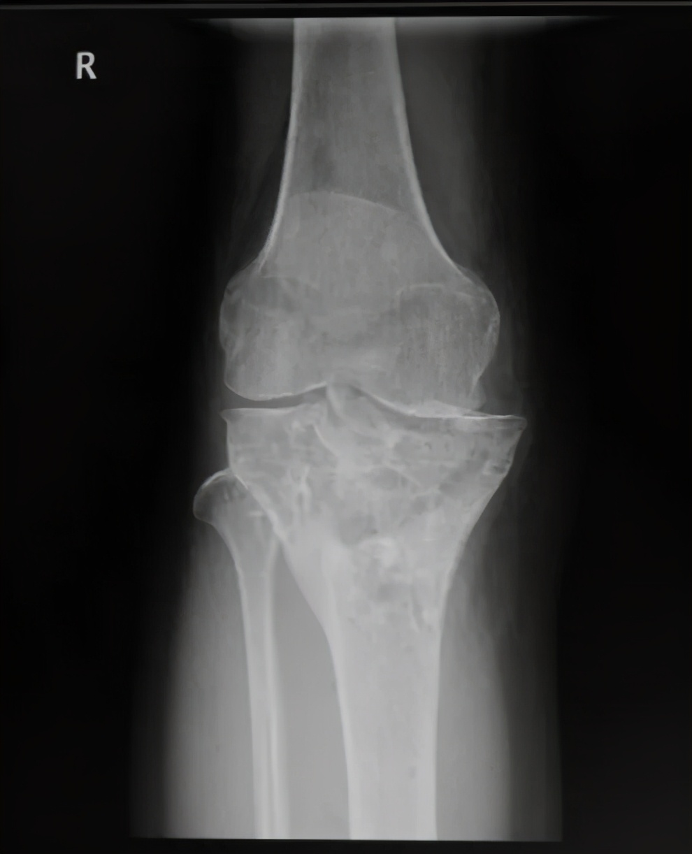 「病例精选」不用换关节，TCVO手术给您新“膝”望