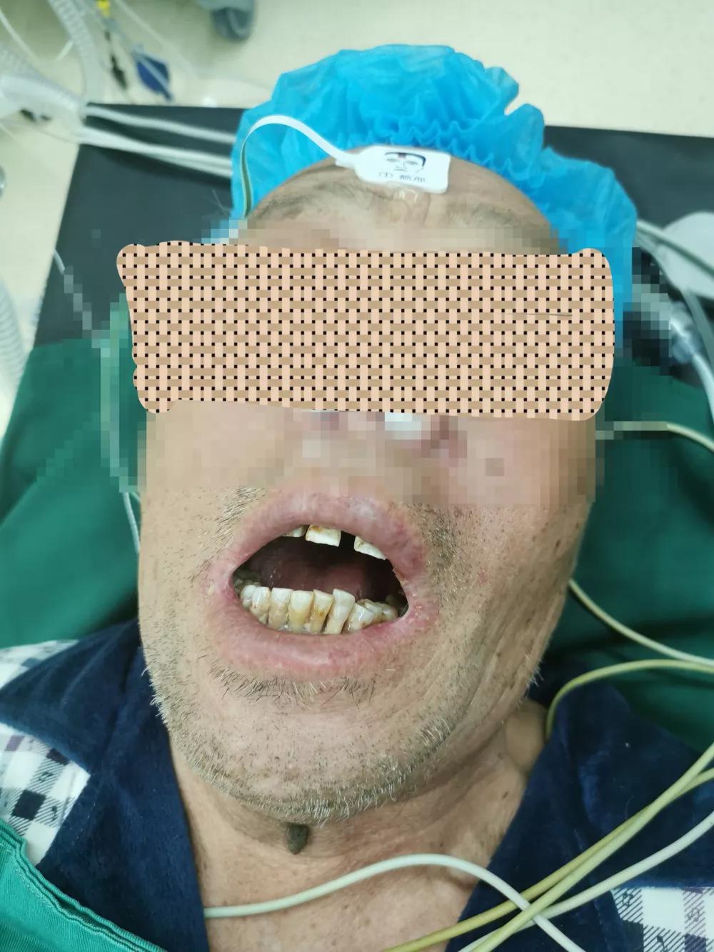 困难气道插管视频,困难插管