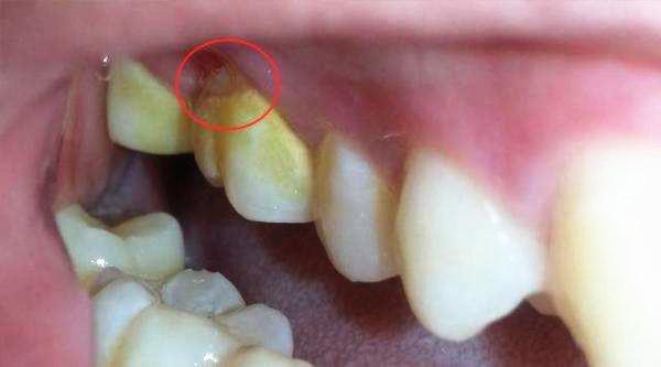 牙缝里黄黄的硬的,牙缝里臭臭的黄泥