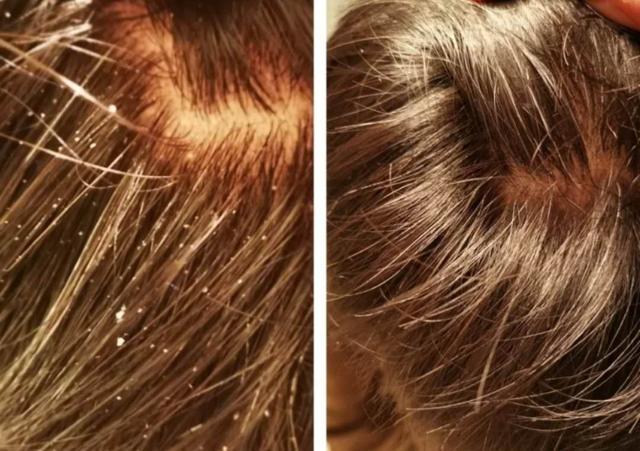 专治大油头的洗发露,拿什么洗发水拯救你的油头