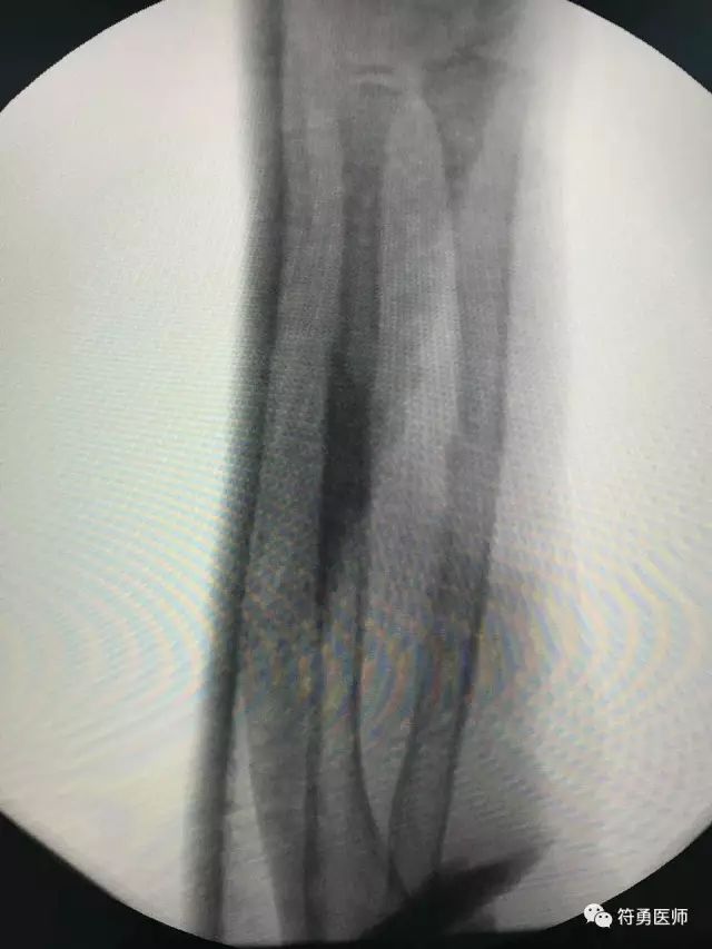 孩子骨折了一定要做打钢针手术吗,儿童摔伤骨折需要手术么