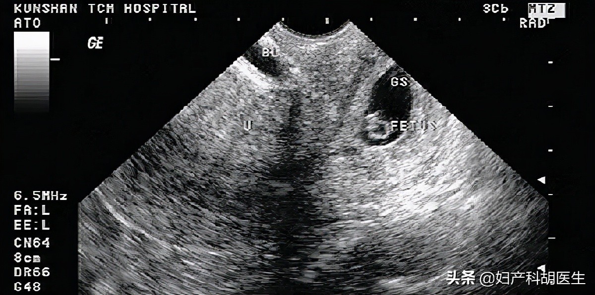 人工流产真实例子,人工流产的悲催案例