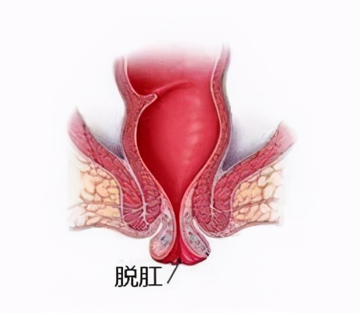 “菊花”不适，不一定都是“痔疮”的锅